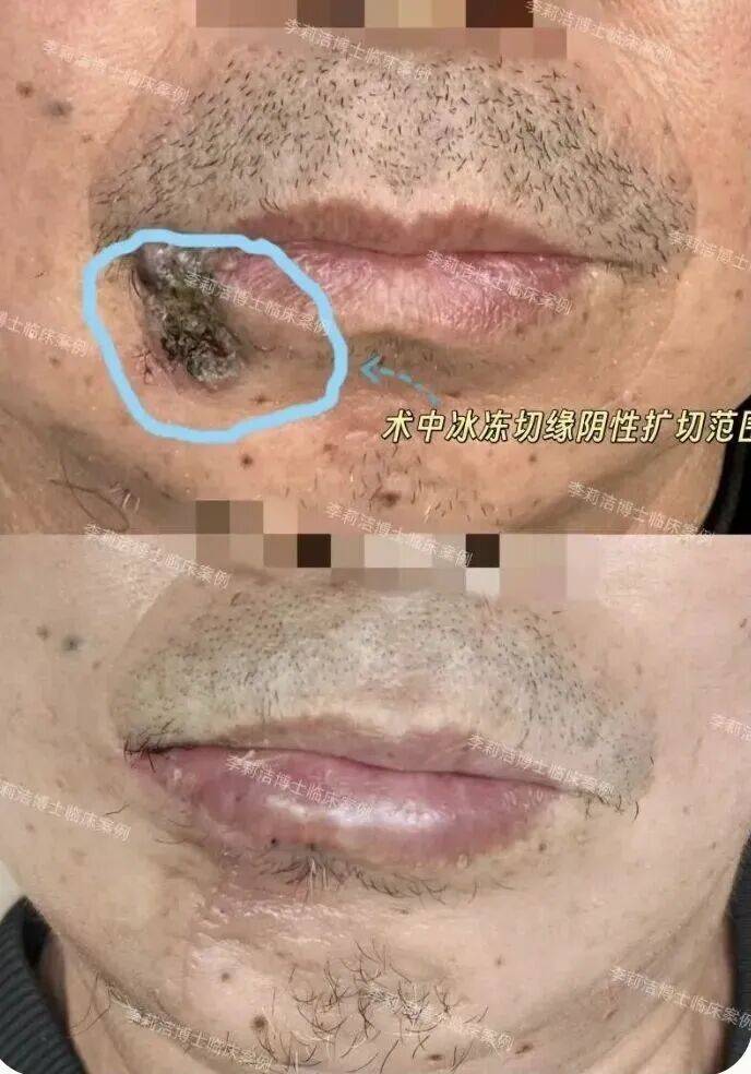 57岁男子把唇上肿瘤当痘痘挤了8年,医生提醒